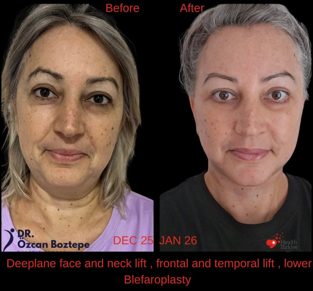 Op. Dr. Özcan Boztepe — Klinik Vaka 12