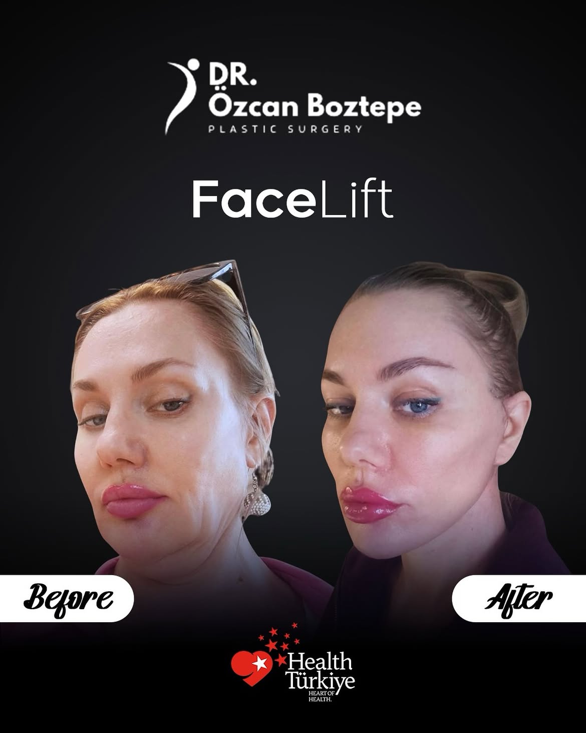 Op. Dr. Özcan Boztepe — Klinik Vaka 16