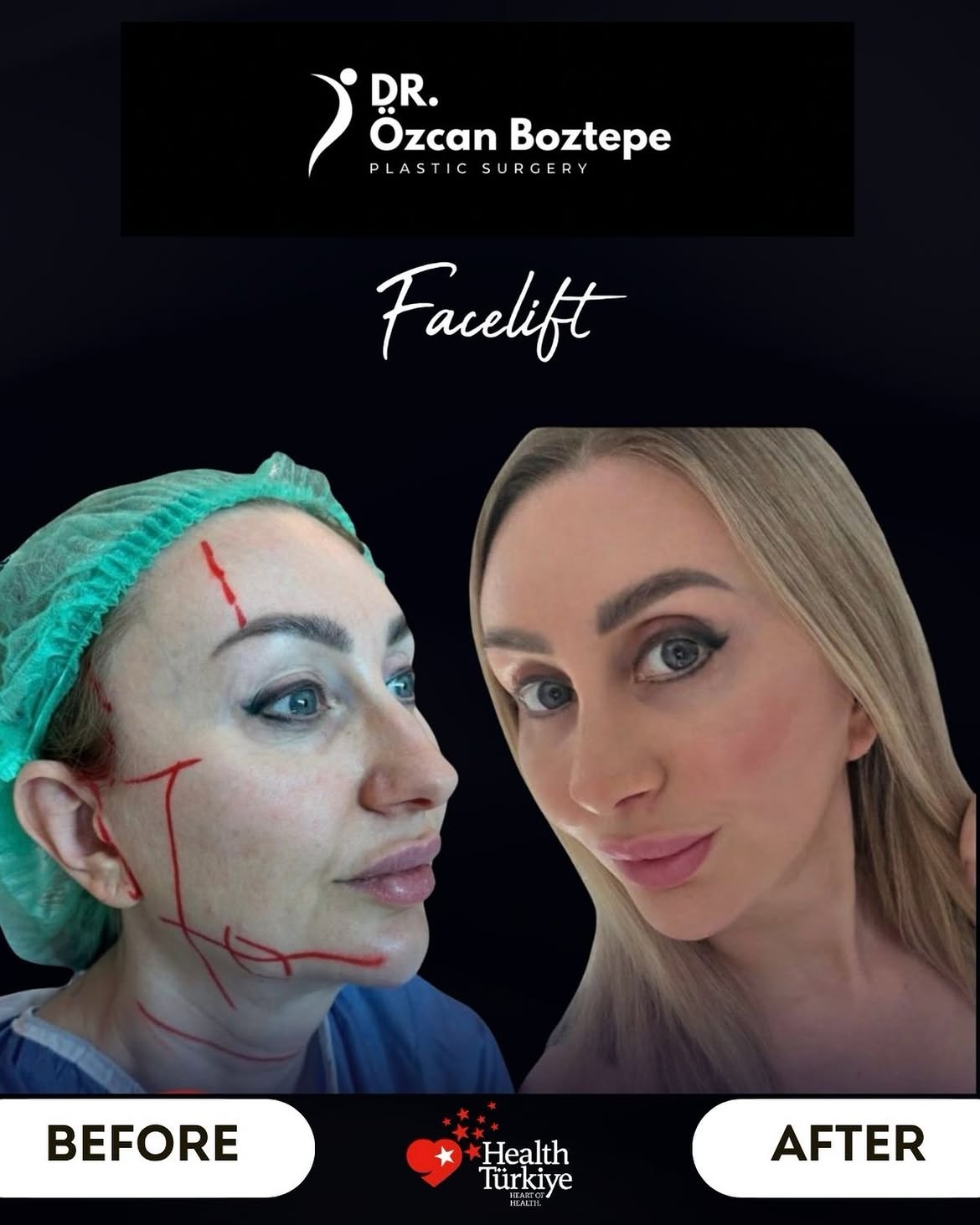 Op. Dr. Özcan Boztepe — Klinik Vaka 17