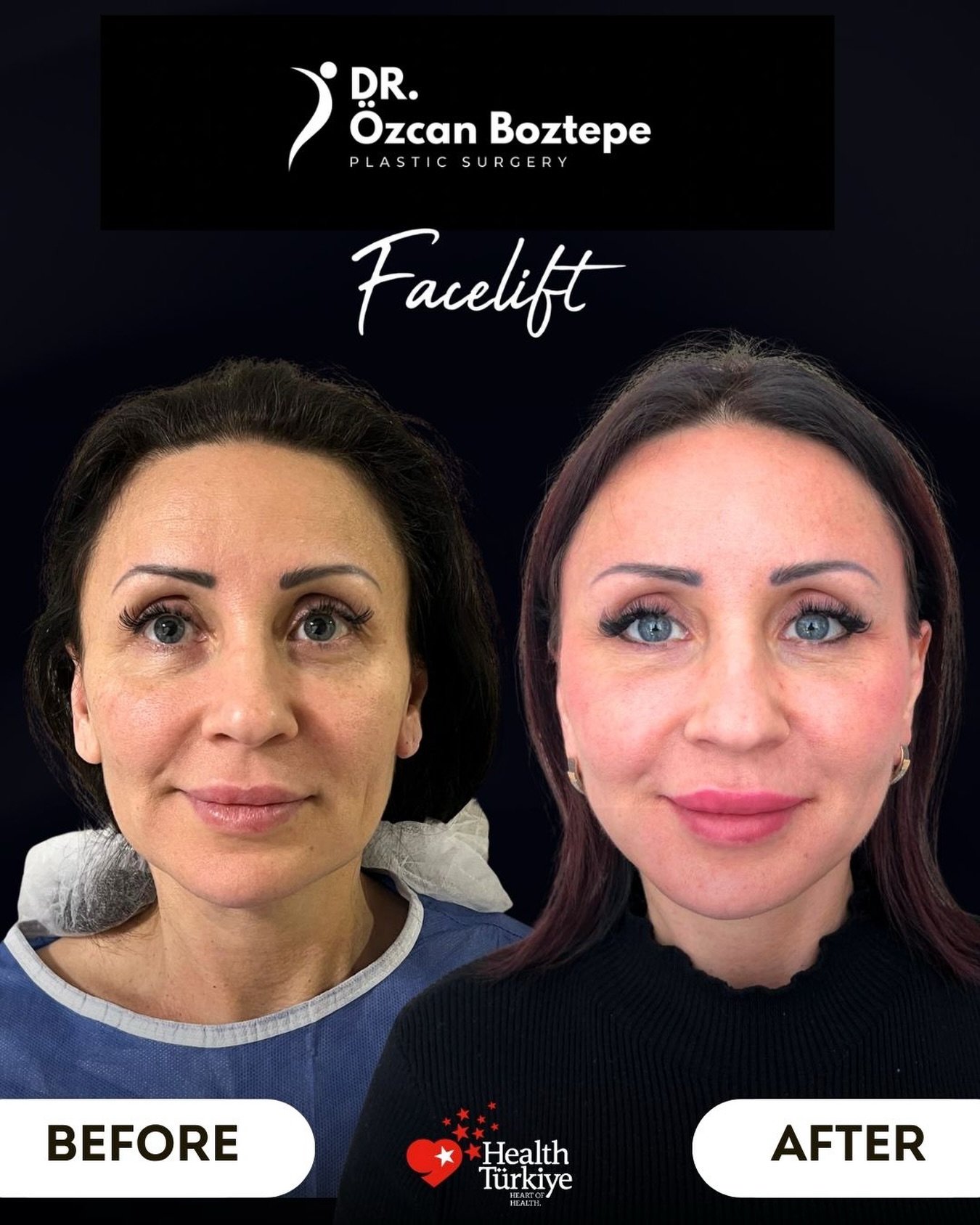 Op. Dr. Özcan Boztepe — Klinik Vaka 18