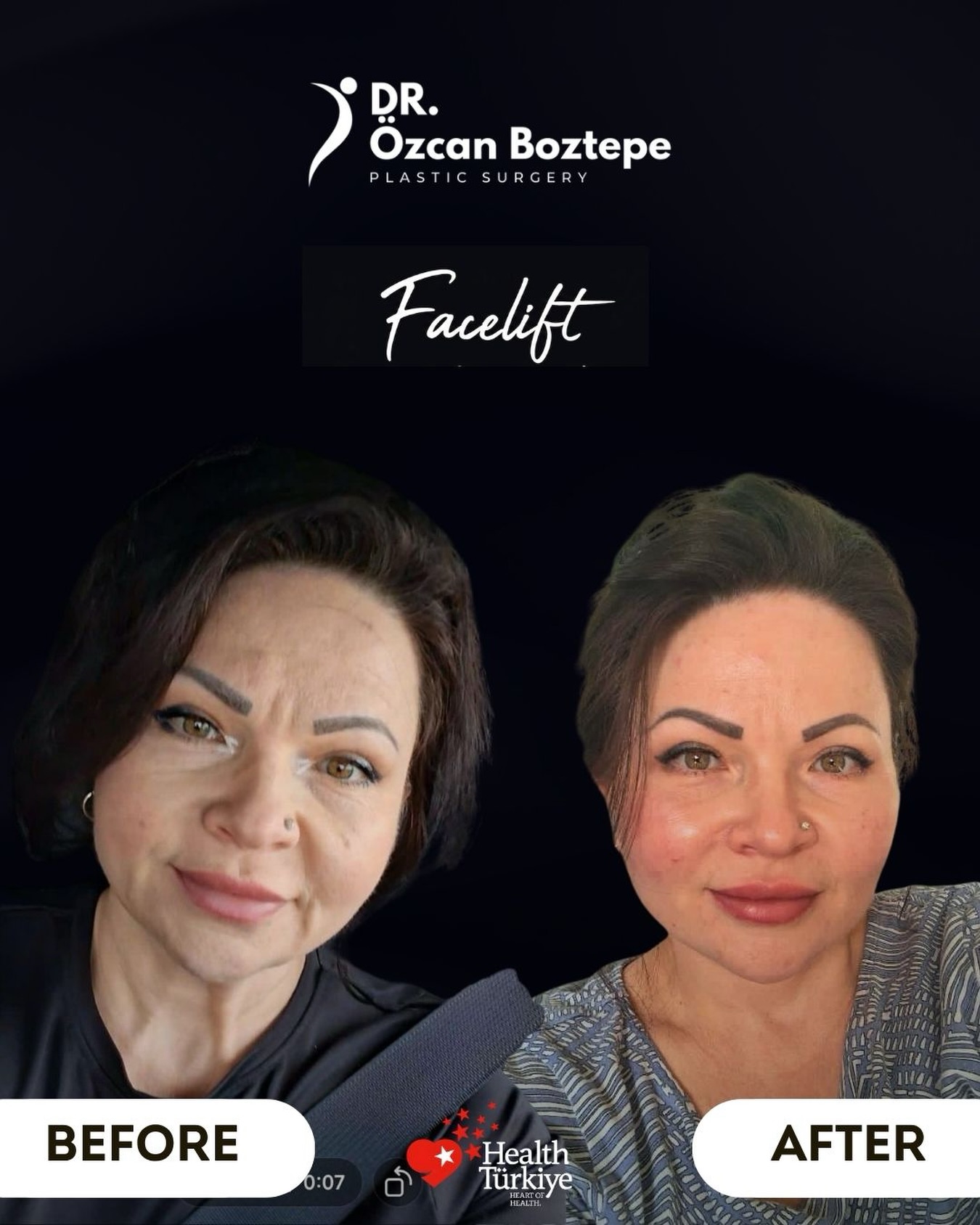 Op. Dr. Özcan Boztepe — Klinik Vaka 19