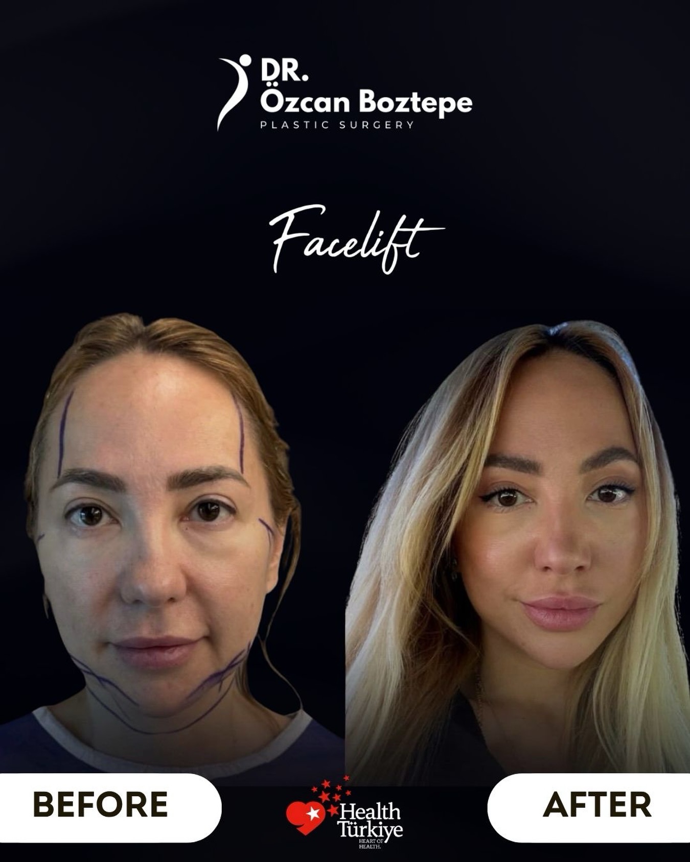 Op. Dr. Özcan Boztepe — Klinik Vaka 20