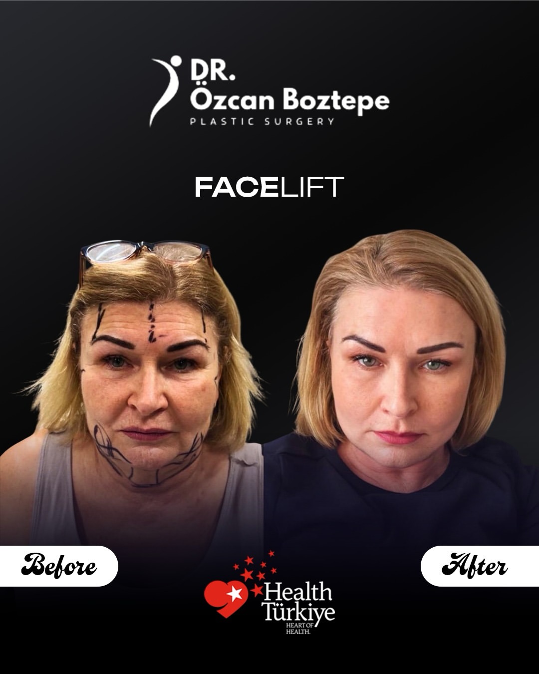 Op. Dr. Özcan Boztepe — Klinik Vaka 21