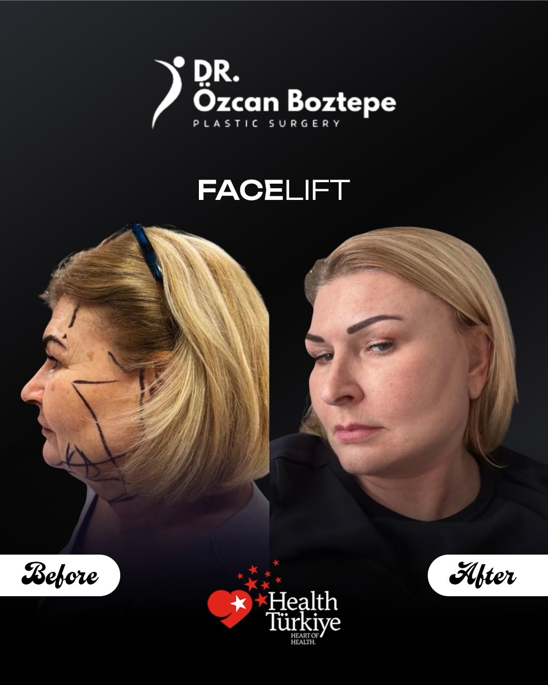 Op. Dr. Özcan Boztepe — Klinik Vaka 22