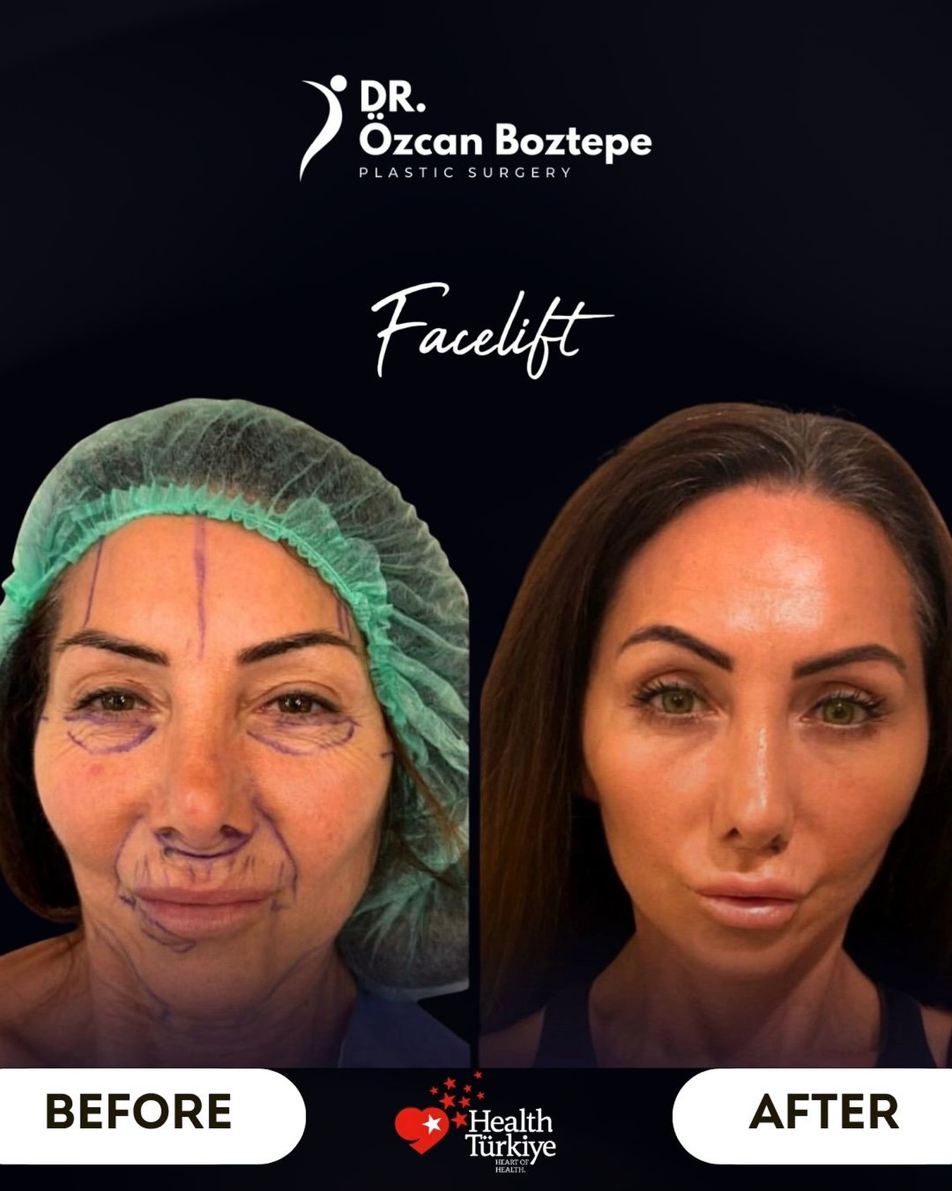 Op. Dr. Özcan Boztepe — Klinik Vaka 7
