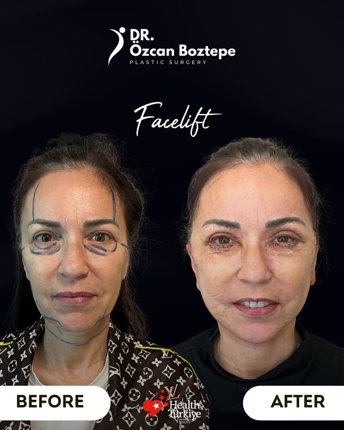 Op. Dr. Özcan Boztepe — Klinik Vaka 23