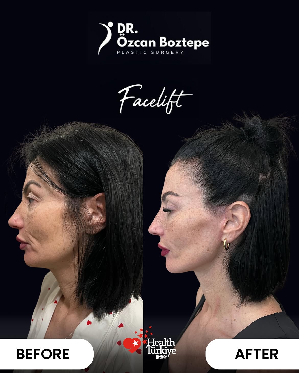 Op. Dr. Özcan Boztepe — Klinik Vaka 24