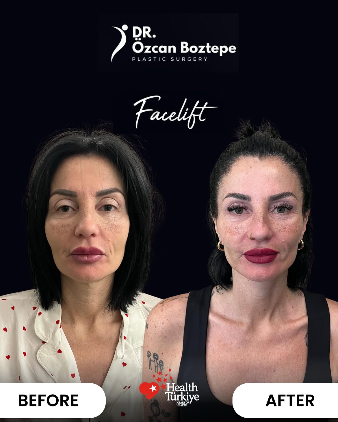 Op. Dr. Özcan Boztepe — Klinik Vaka 25