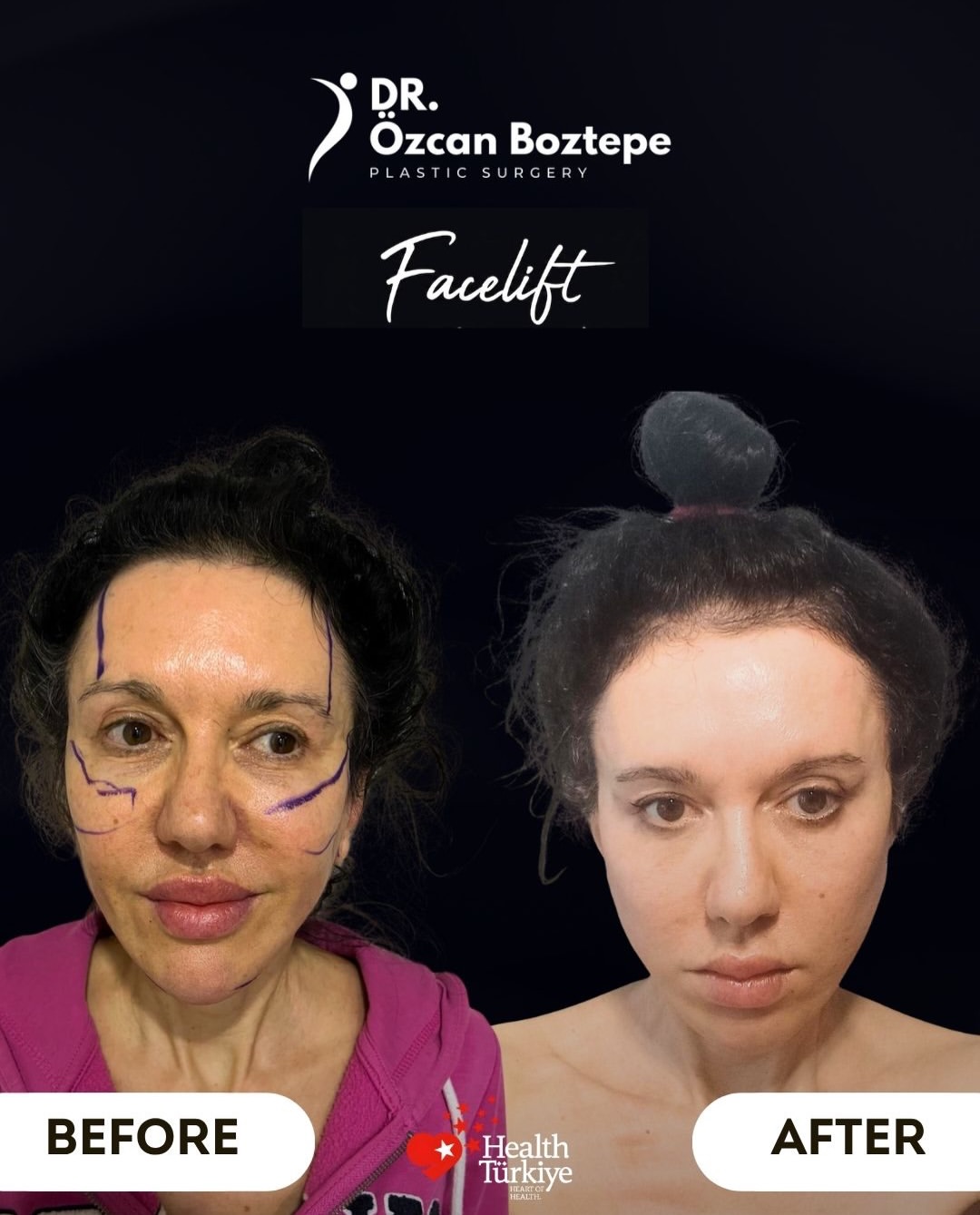 Op. Dr. Özcan Boztepe — Klinik Vaka 26