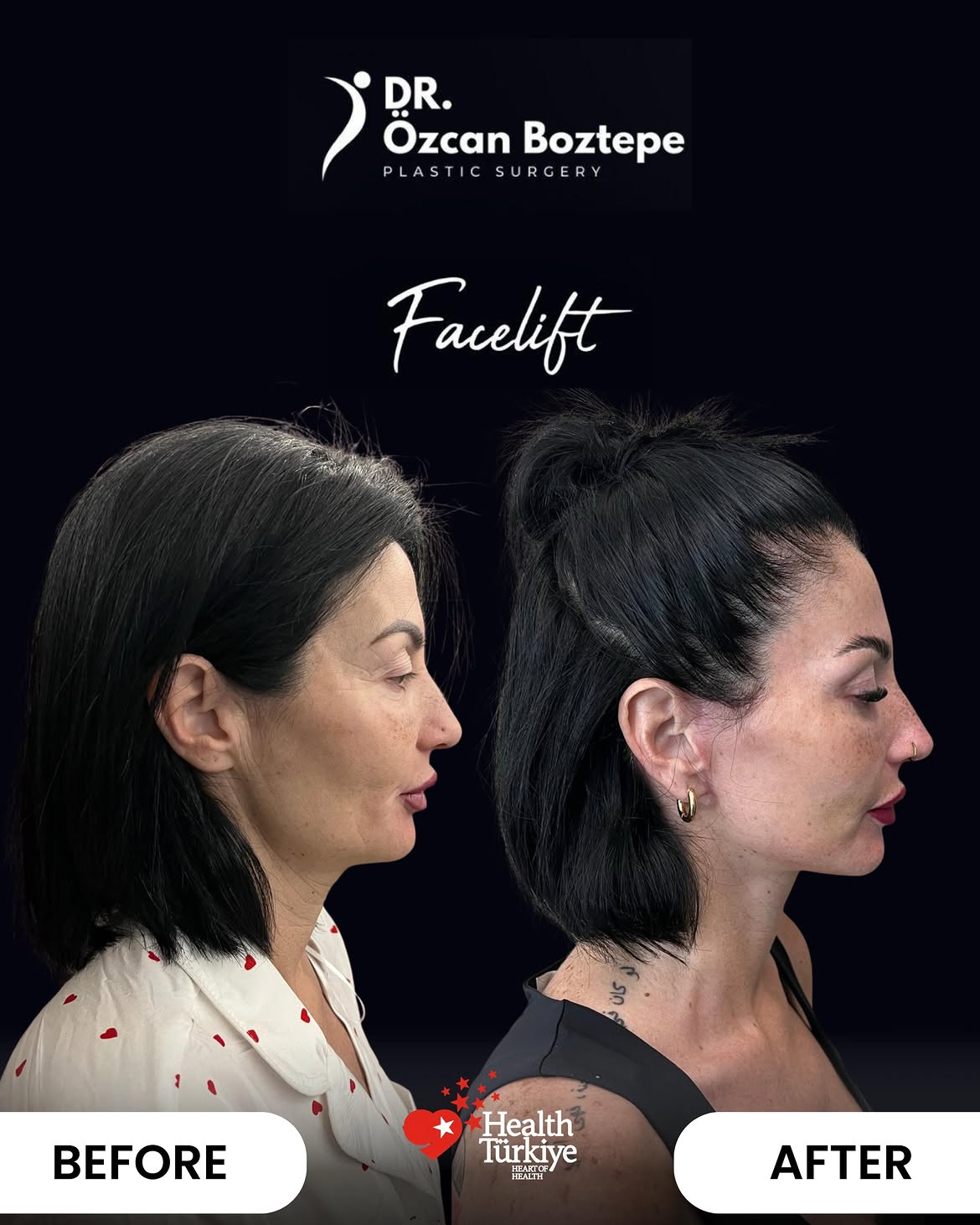 Op. Dr. Özcan Boztepe — Klinik Vaka 27
