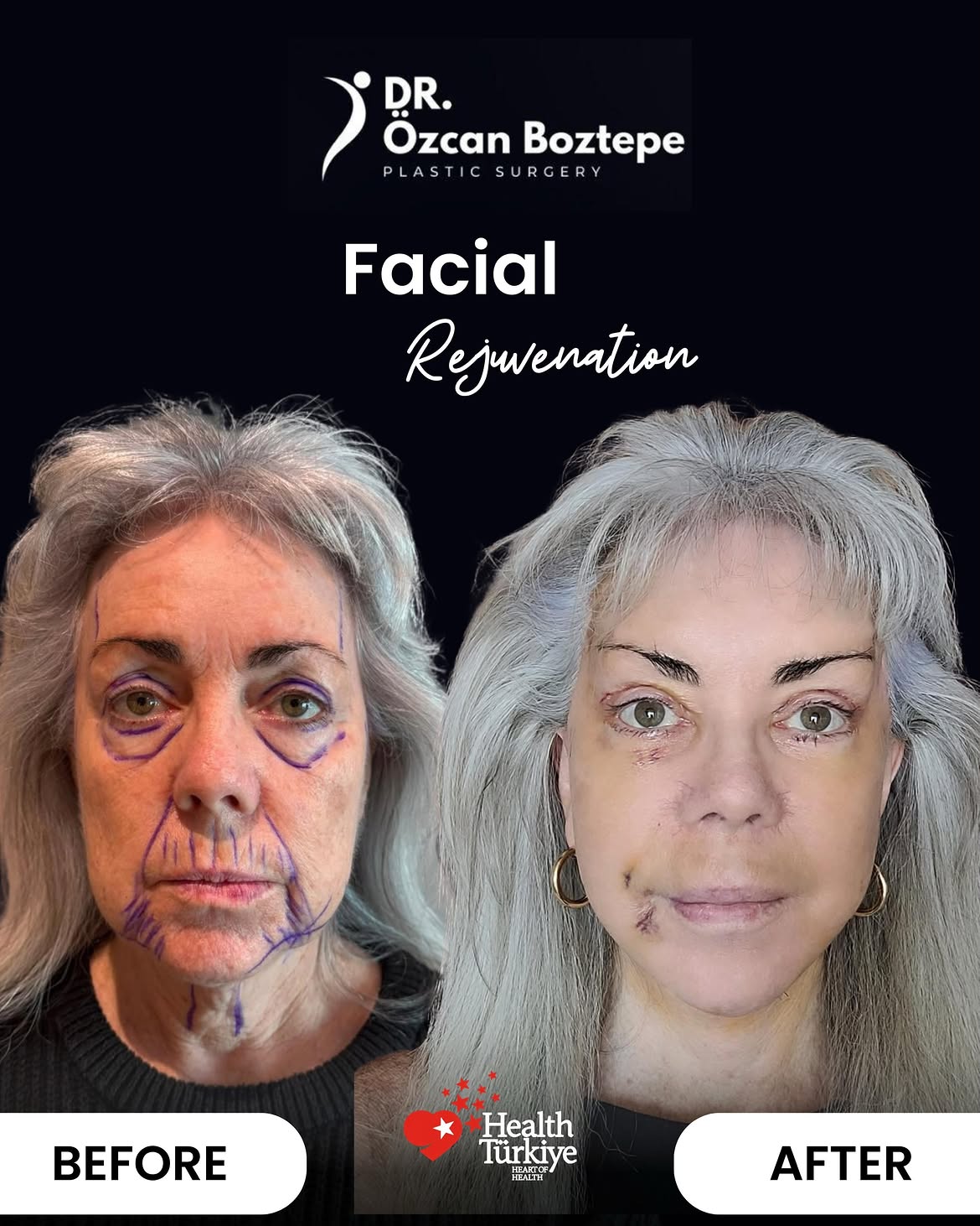 Op. Dr. Özcan Boztepe — Klinik Vaka 28