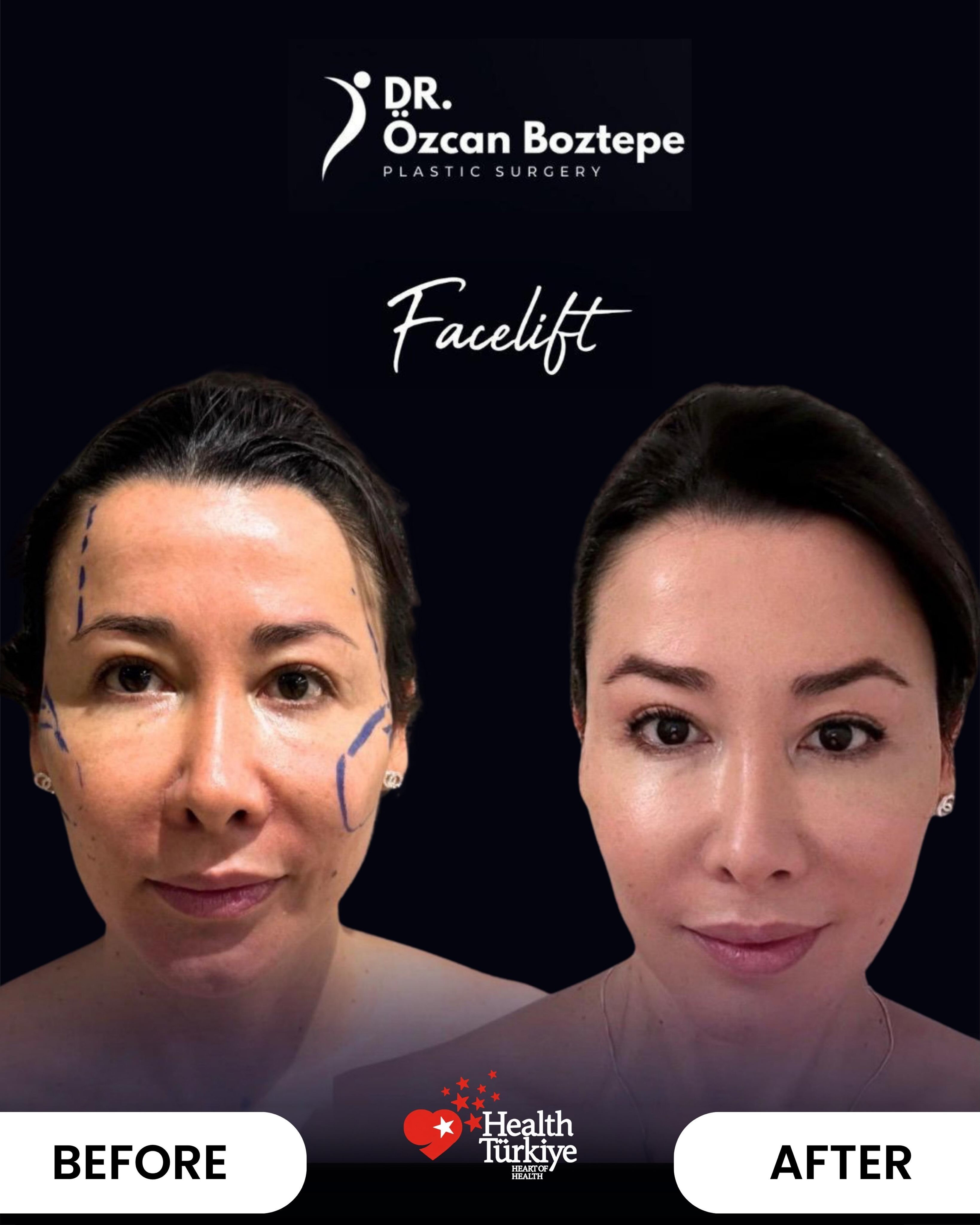 Op. Dr. Özcan Boztepe — Klinik Vaka 30