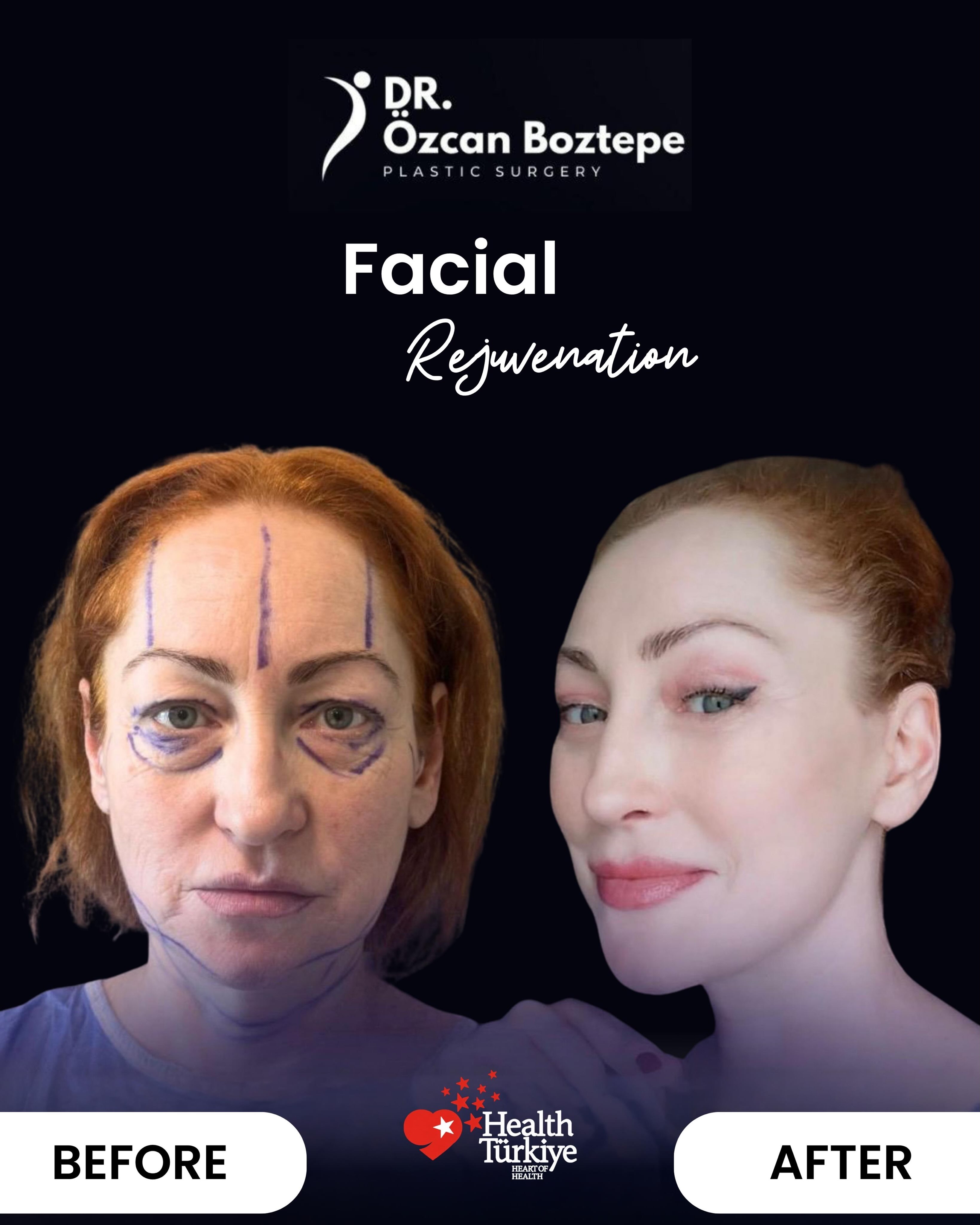 Op. Dr. Özcan Boztepe — Klinik Vaka 31