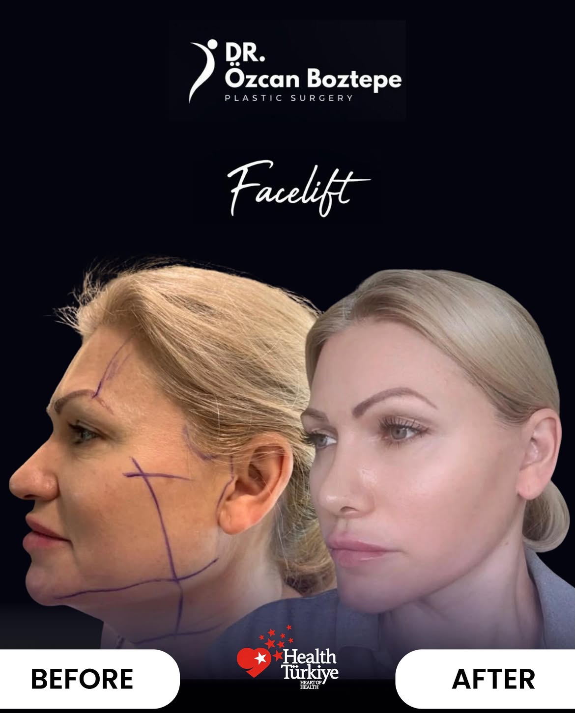 Op. Dr. Özcan Boztepe — Klinik Vaka 33