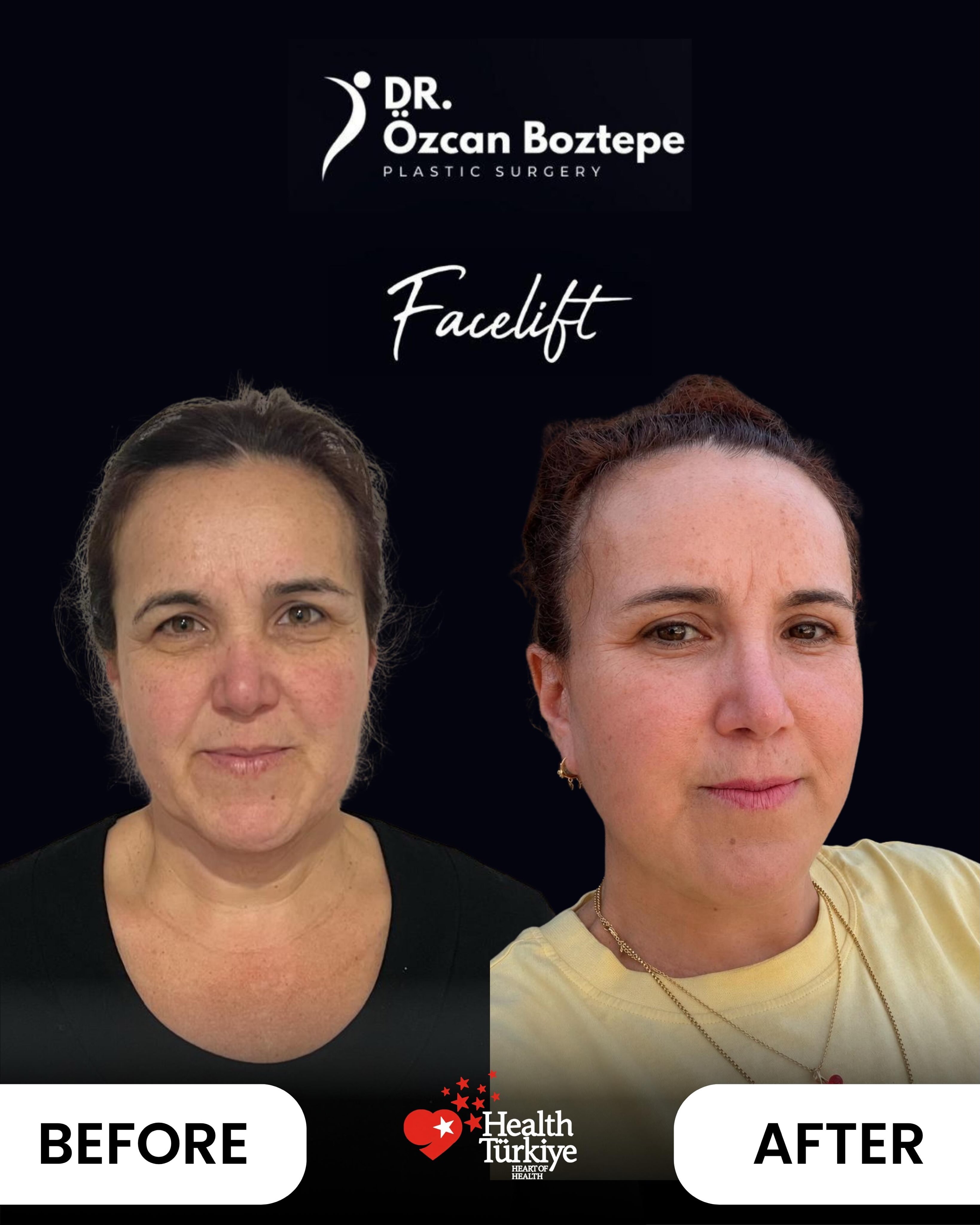 Op. Dr. Özcan Boztepe — Klinik Vaka 34