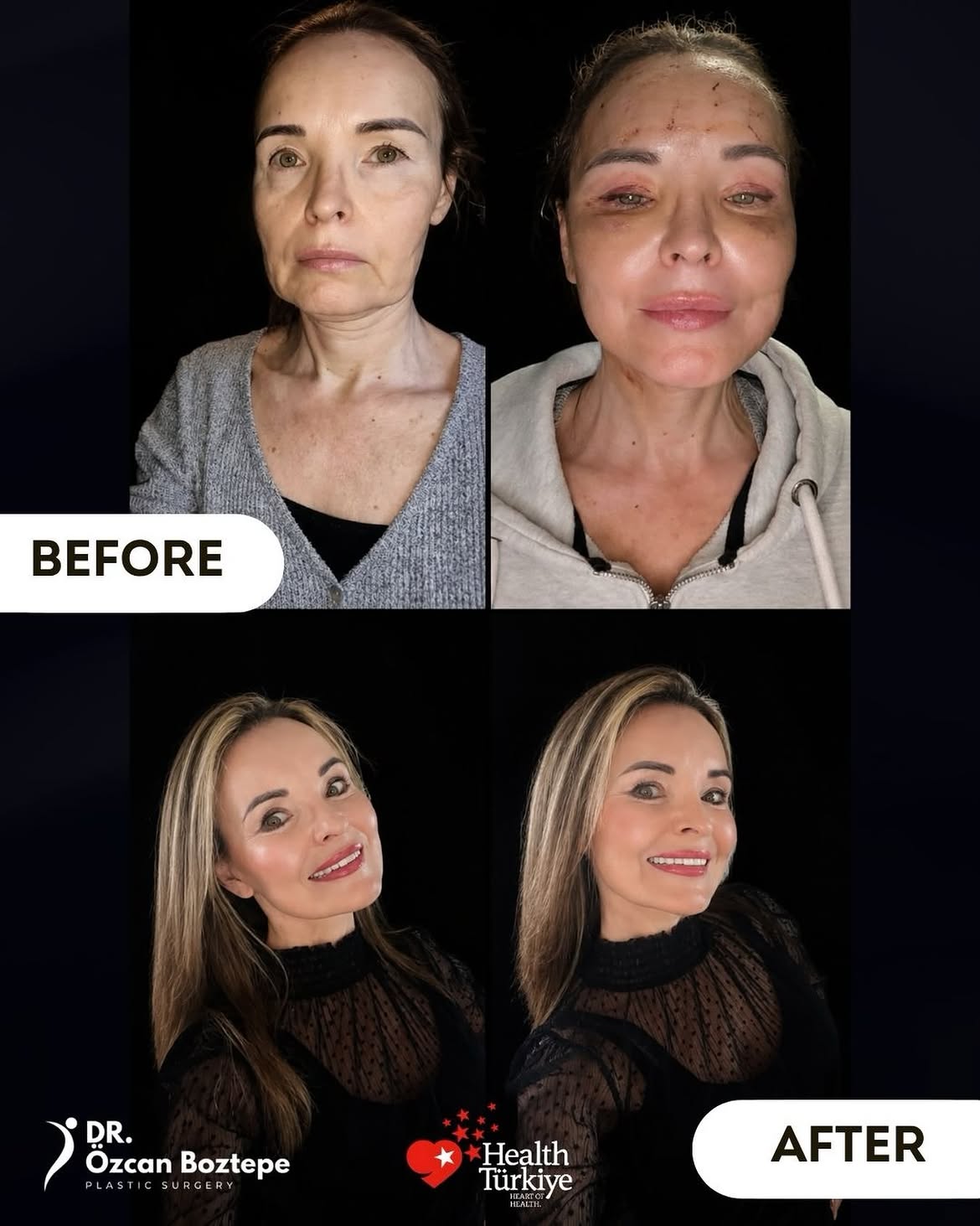 Op. Dr. Özcan Boztepe — Klinik Vaka 37