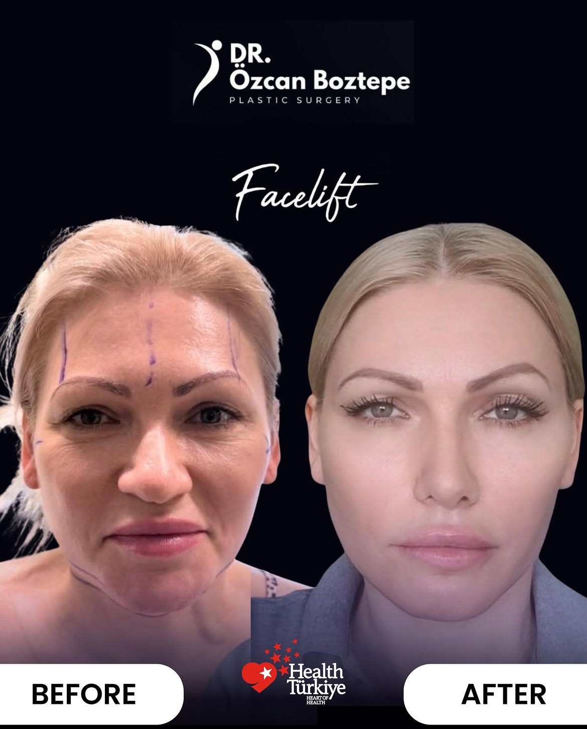 Op. Dr. Özcan Boztepe — Klinik Vaka 38