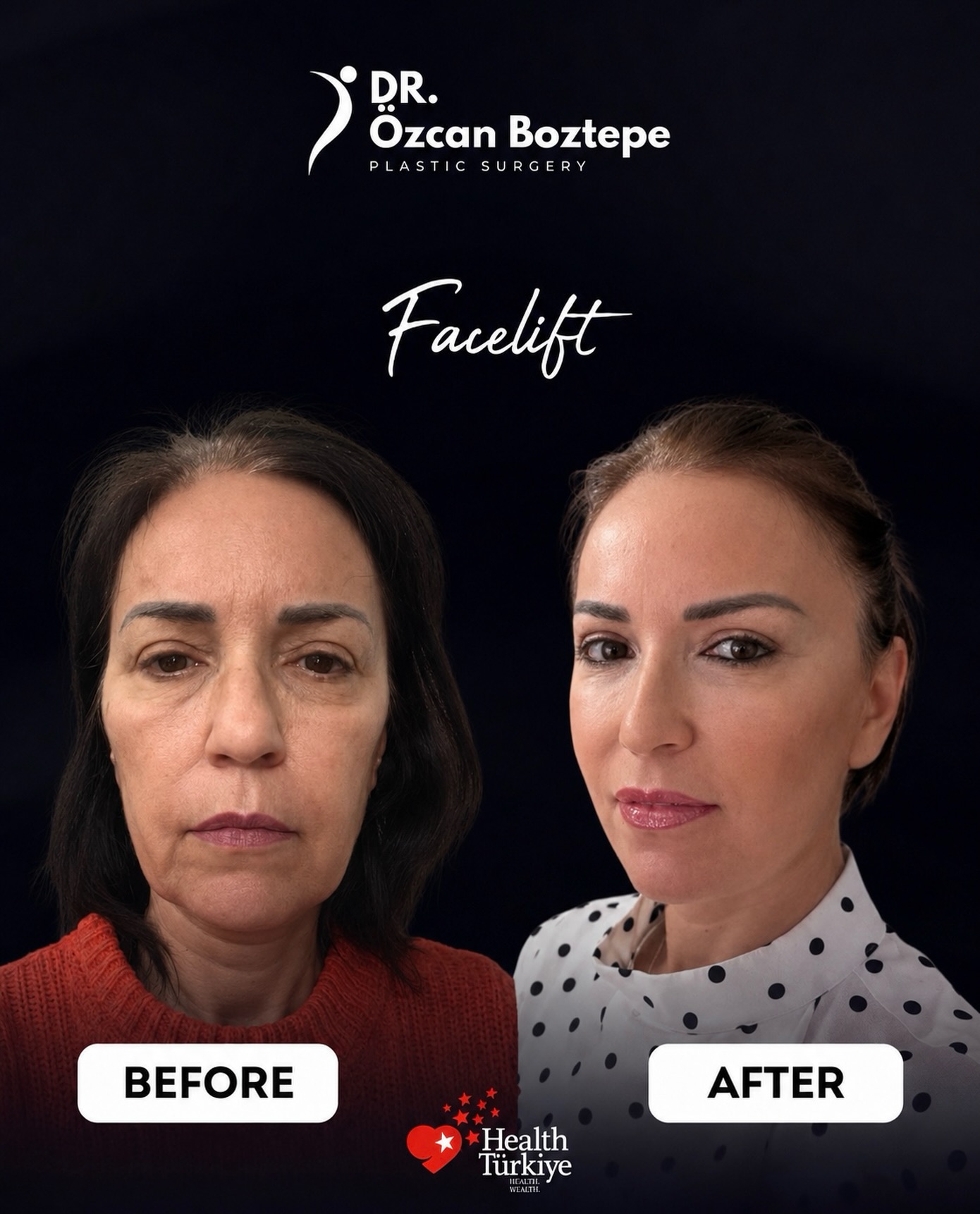 Op. Dr. Özcan Boztepe — Klinik Vaka 39