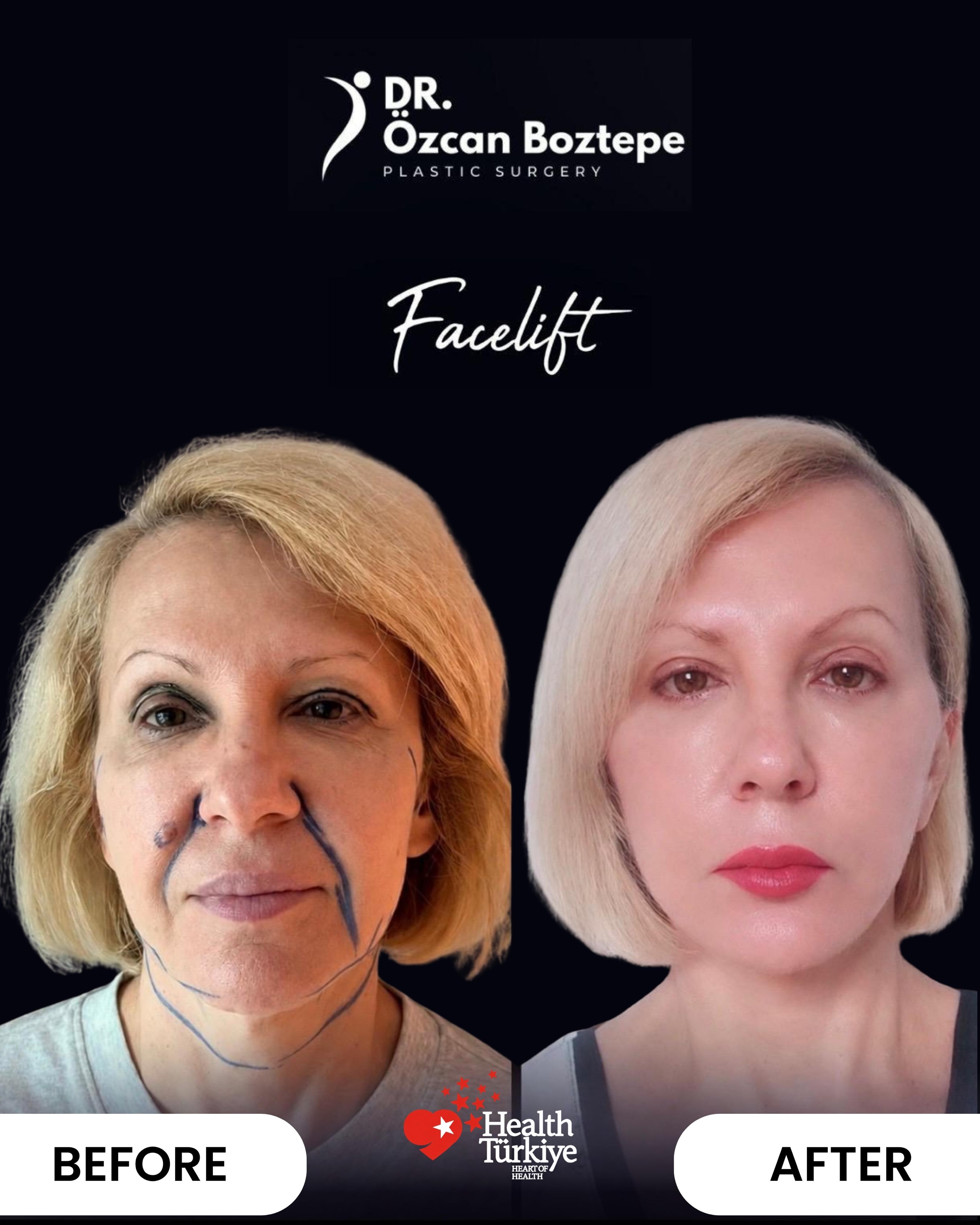 Op. Dr. Özcan Boztepe — Klinik Vaka 40