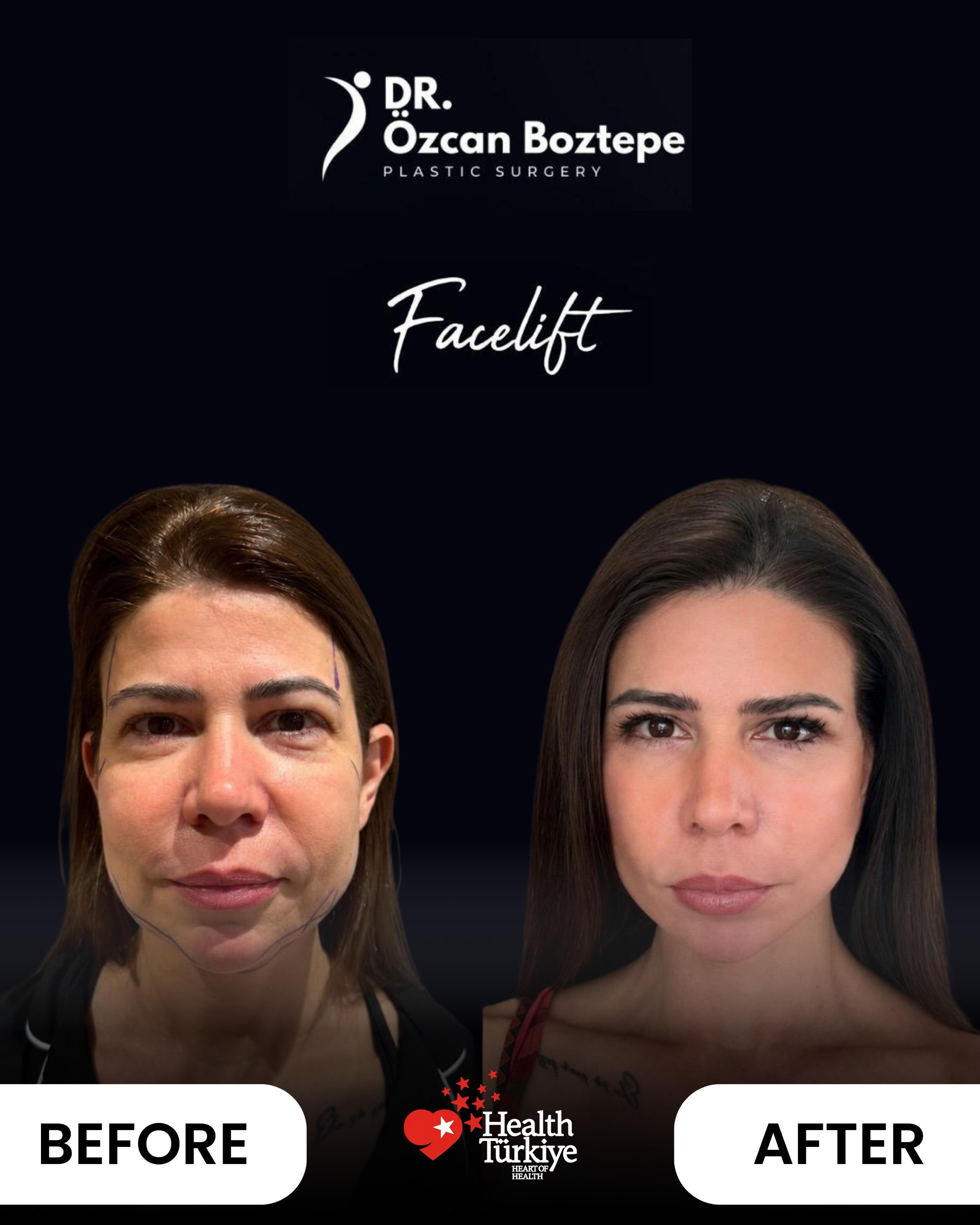 Op. Dr. Özcan Boztepe — Klinik Vaka 41