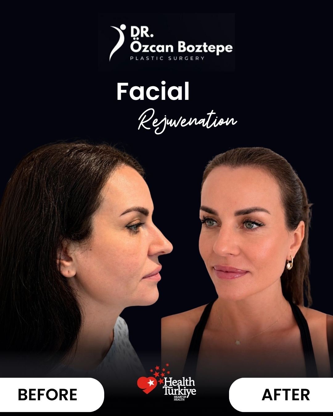 Op. Dr. Özcan Boztepe — Klinik Vaka 44