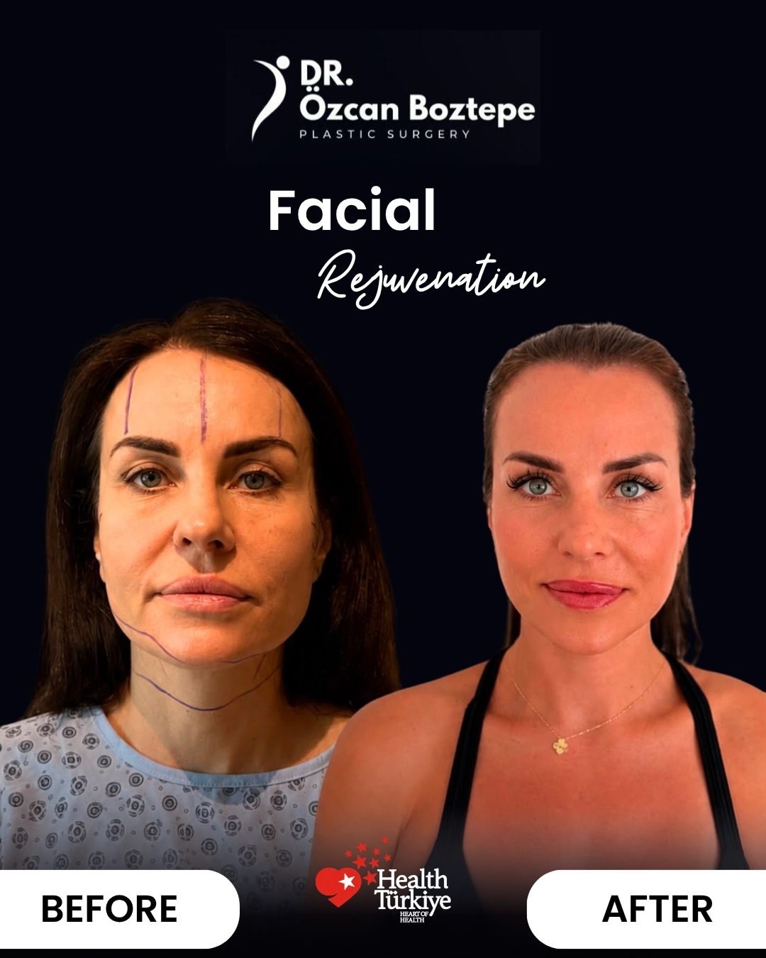 Op. Dr. Özcan Boztepe — Klinik Vaka 45