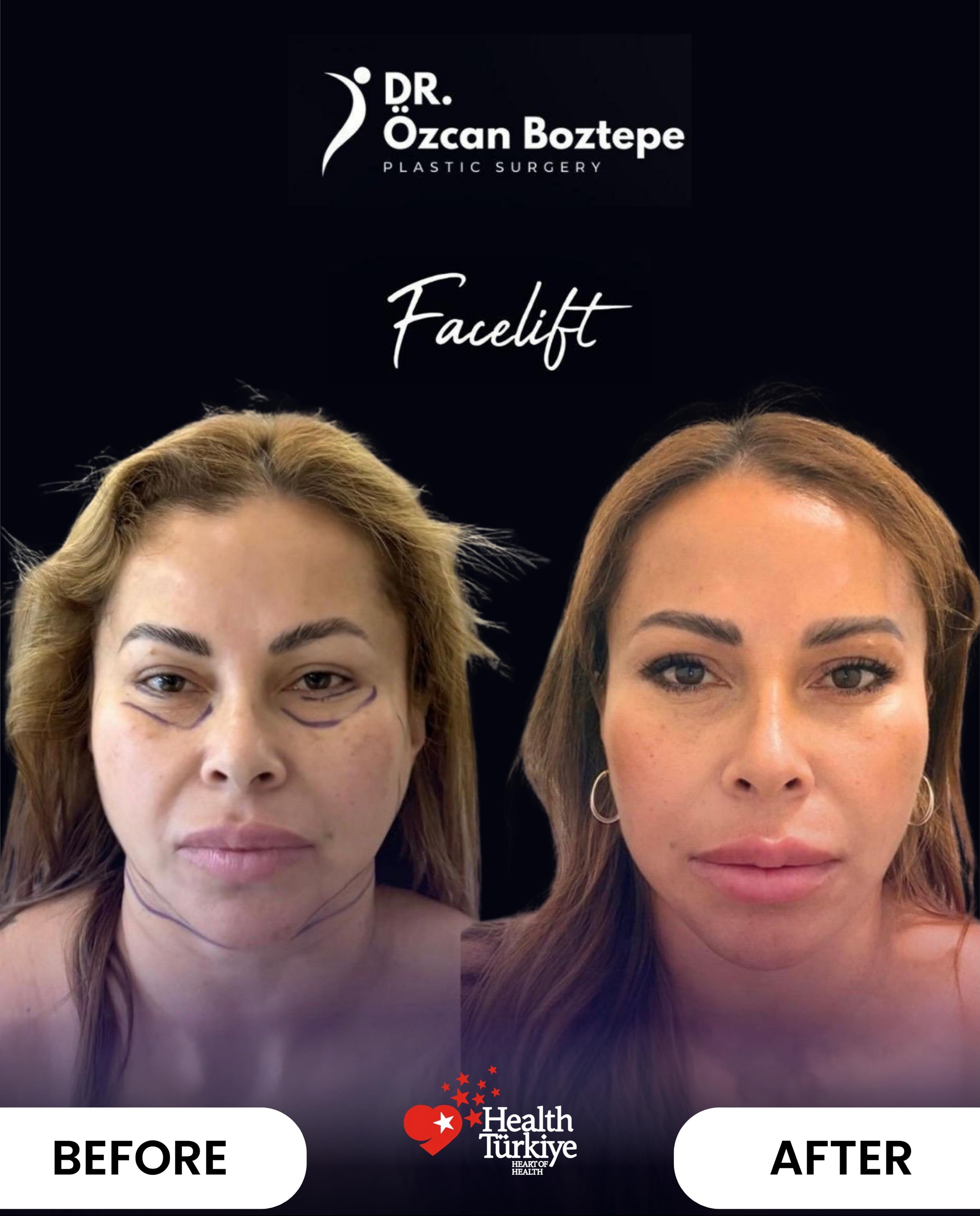 Op. Dr. Özcan Boztepe — Klinik Vaka 5
