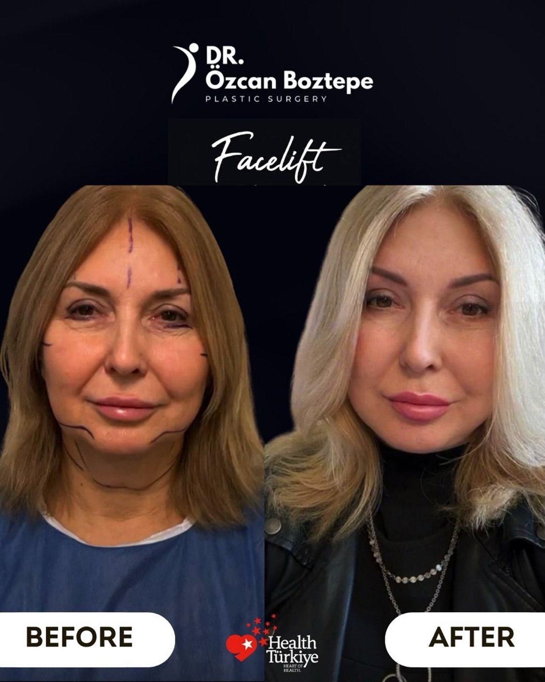 Op. Dr. Özcan Boztepe — Klinik Vaka 46