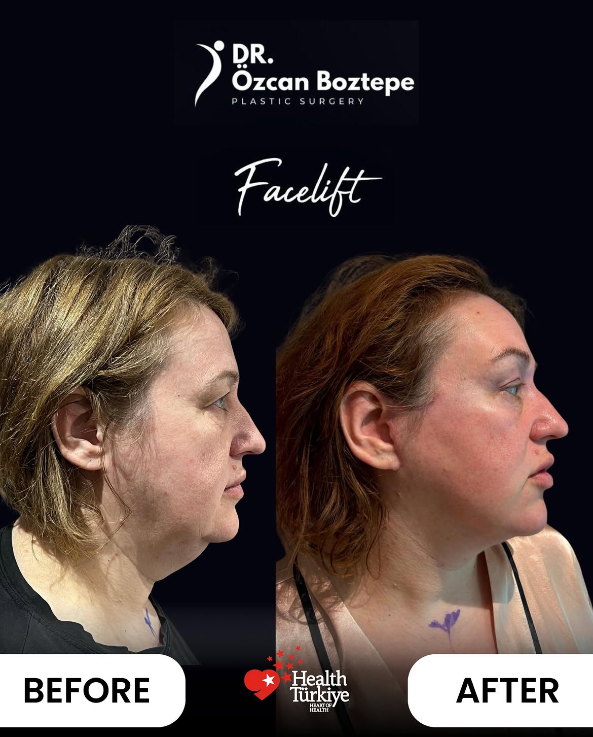 Op. Dr. Özcan Boztepe — Klinik Vaka 47