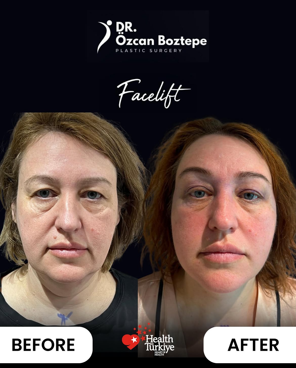 Op. Dr. Özcan Boztepe — Klinik Vaka 48