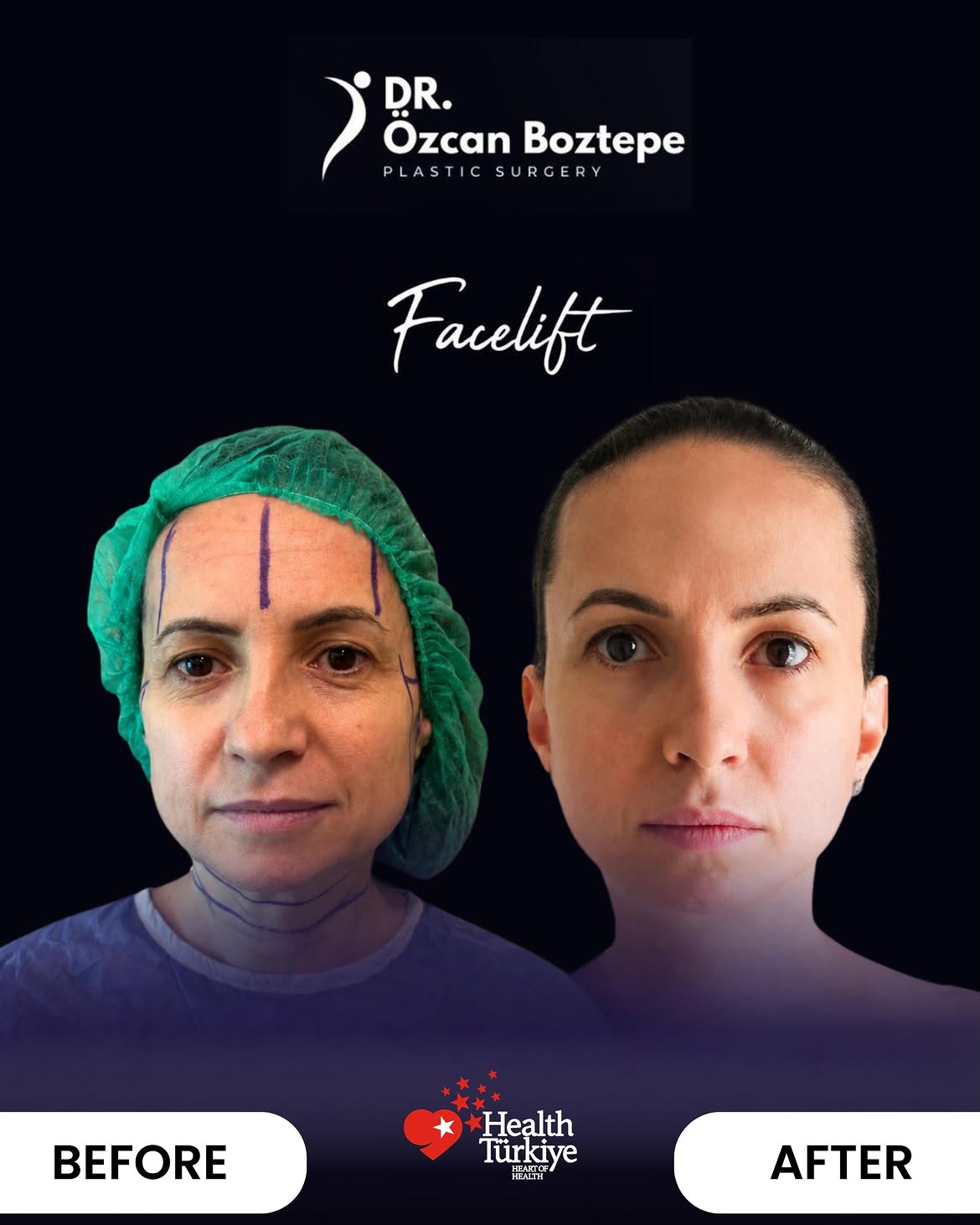 Op. Dr. Özcan Boztepe — Klinik Vaka 49
