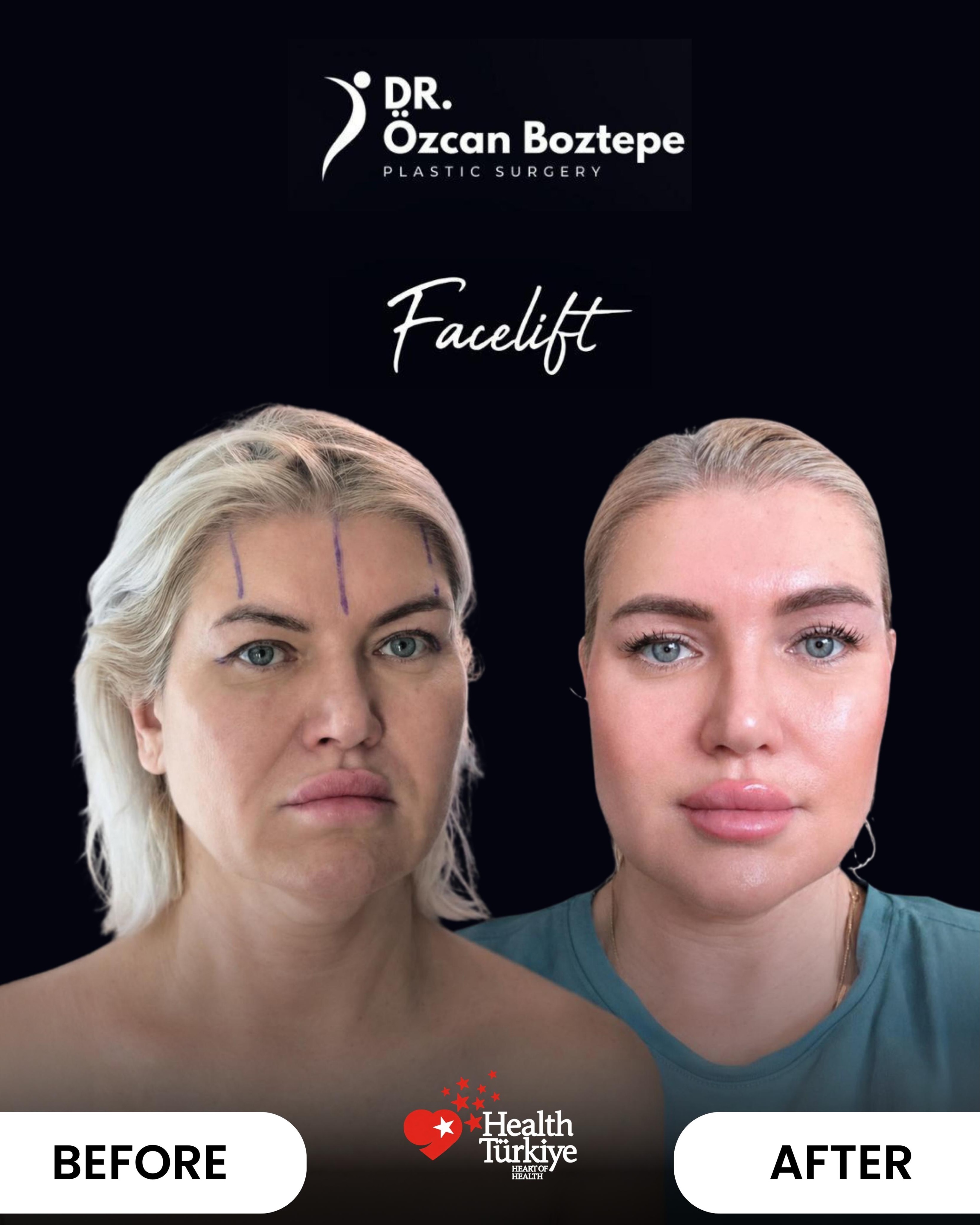 Op. Dr. Özcan Boztepe — Klinik Vaka 50