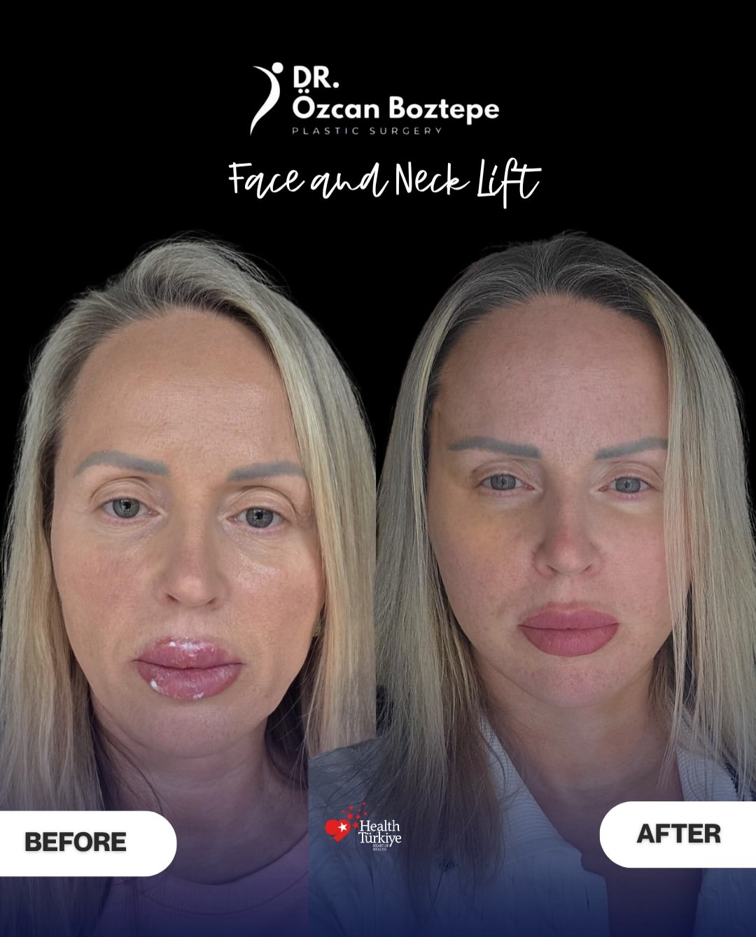 Op. Dr. Özcan Boztepe — Klinik Vaka 51