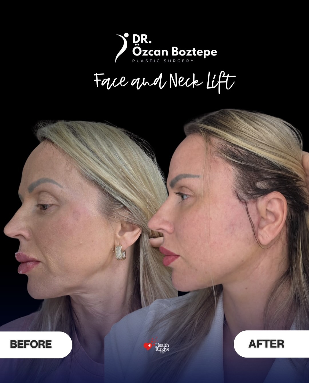 Op. Dr. Özcan Boztepe — Klinik Vaka 52